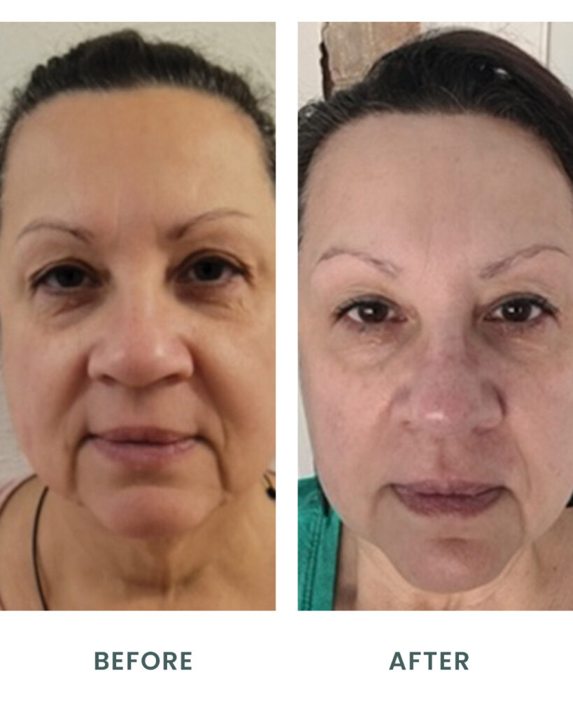 Maxifirm + Peptides Skin Renewal and Lifting Serum Before and After
