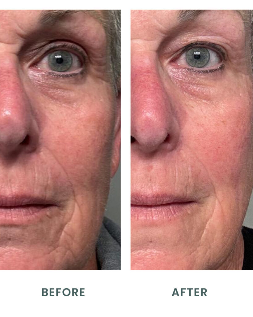 Bakuchiol Retinol Alternative Before and After
