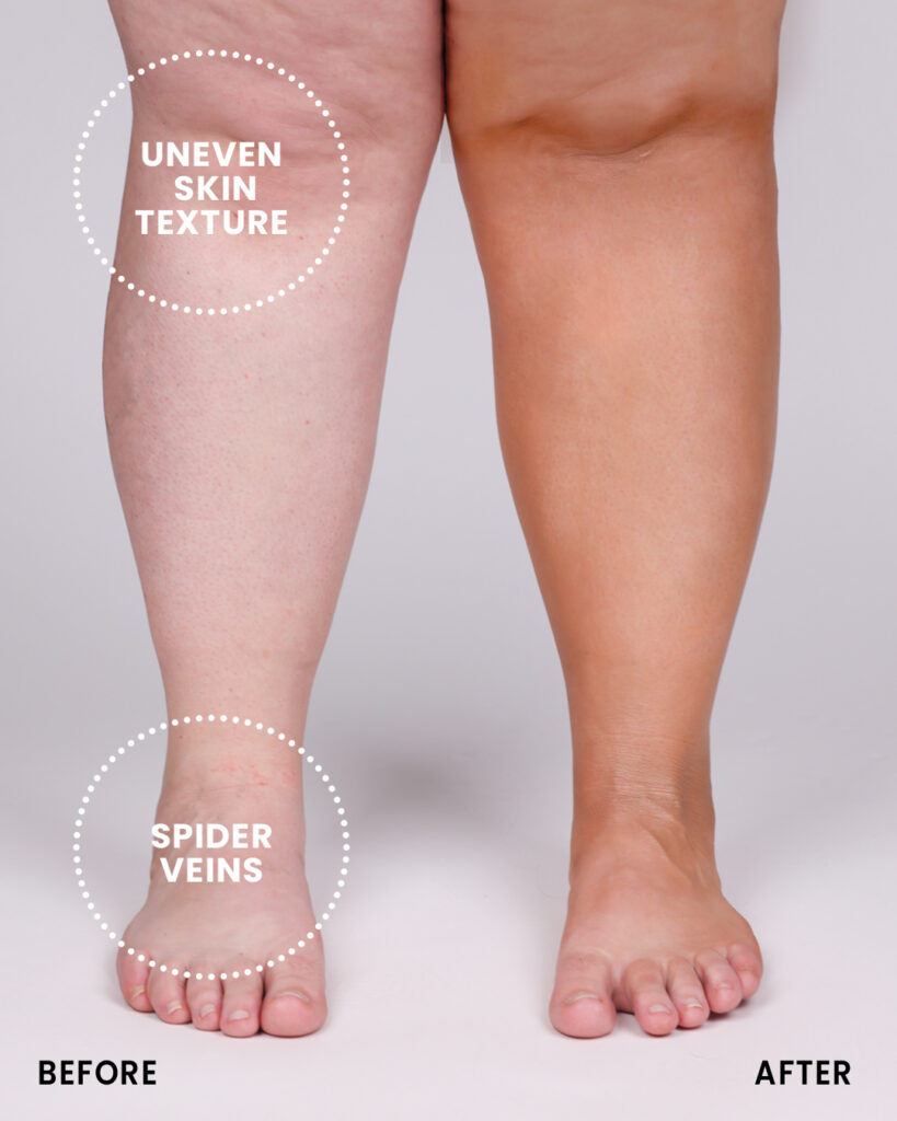 Camouflage Uneven Skin Texture and Spider Veins on Legs