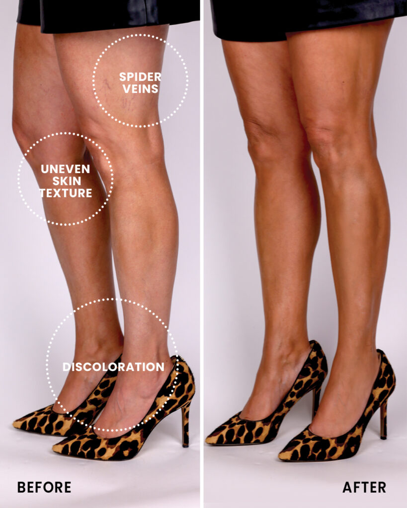 Camouflage Spider Veins, Uneven Skin Texture, and Discoloration on Legs 