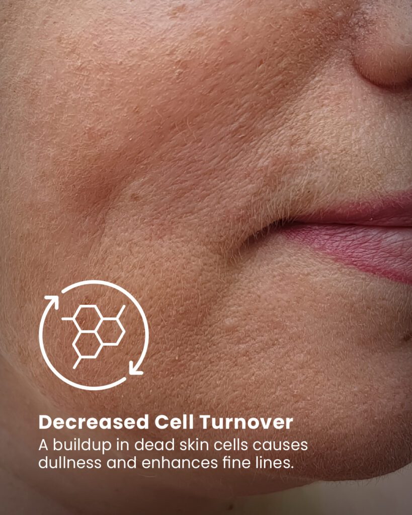 Decreased Cell Turnover