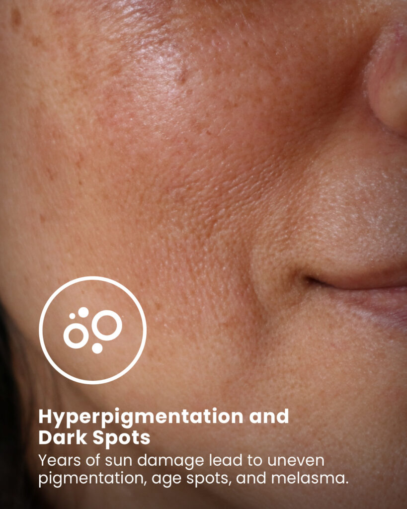 Hyperpigmentation and Dark Spots
