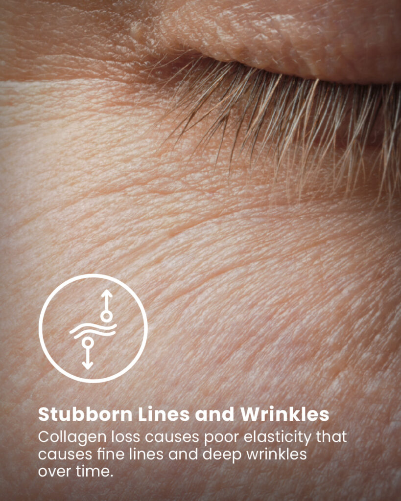 Stubborn Lines and Wrinkles
