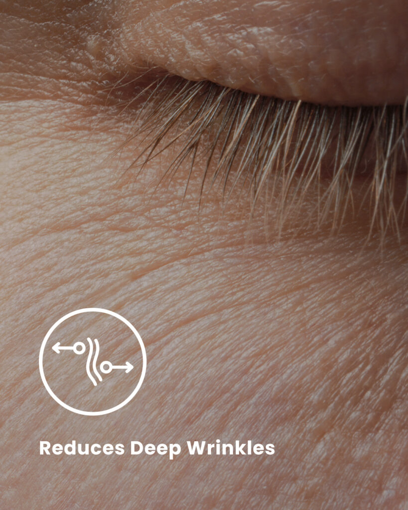 Skin with Deep Wrinkles