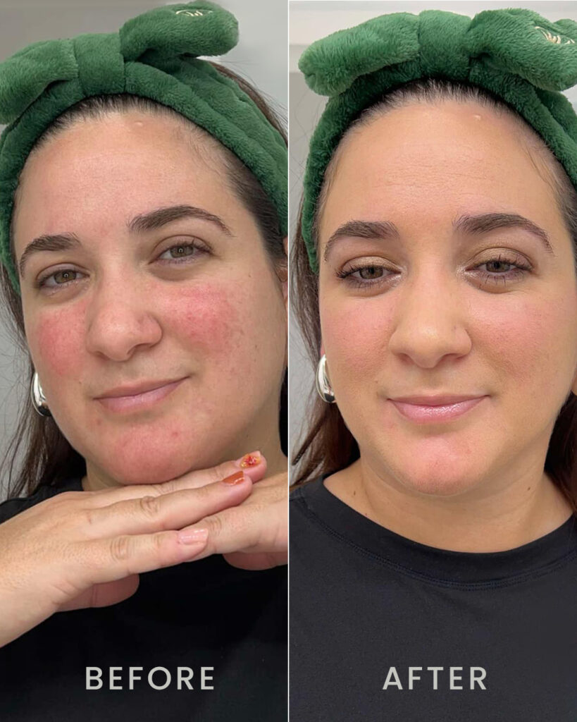 CC+DD Cream Before and after